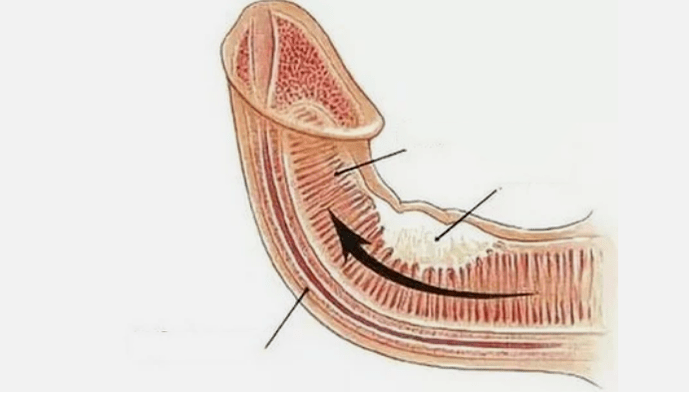 Venous output elimination